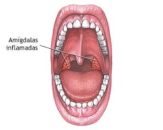 amigdalitis