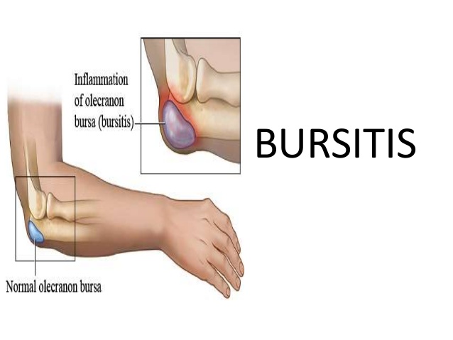 bursitis 2