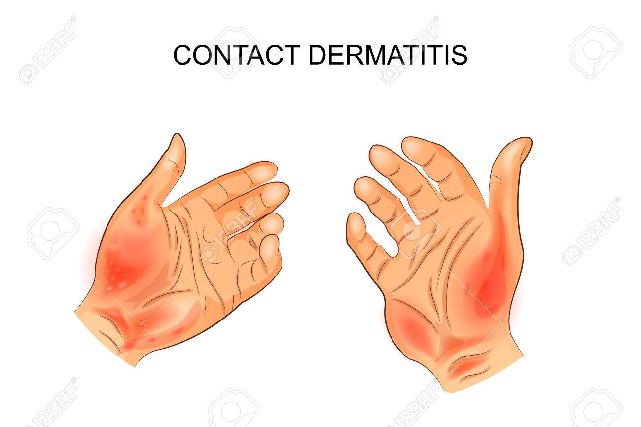 dermatitis de contacto