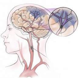 isquemia cerebral