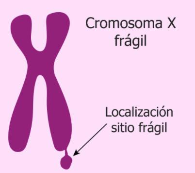 sindrome x fragil