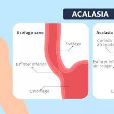 acalasia