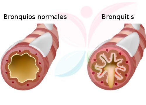 bronquitis