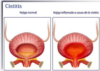 cistitis