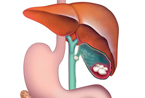 colecistitis