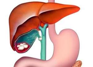 colecistitis cronica