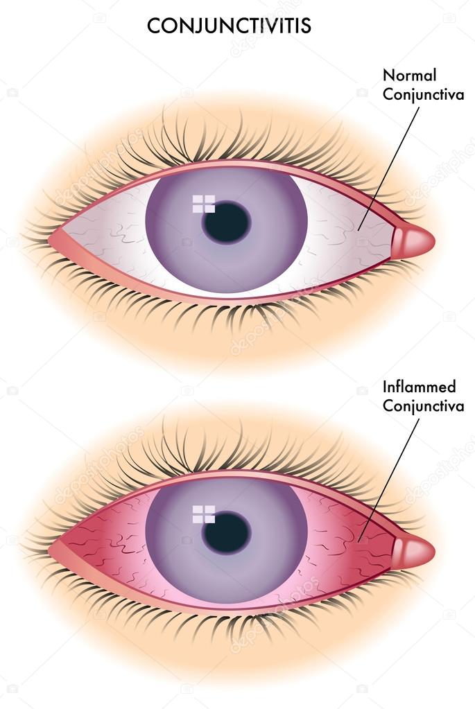 conjuntivitis