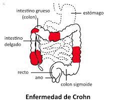 enfermedad de Crohn