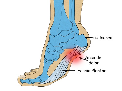 espolon calcaneo