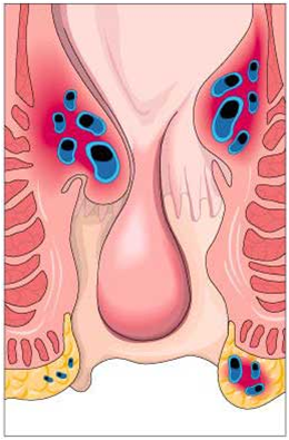 hemorroides