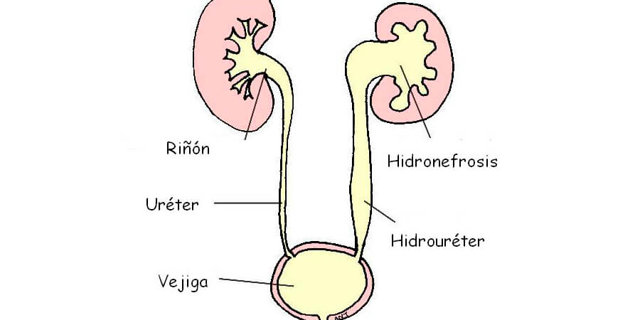 hidronefrosis