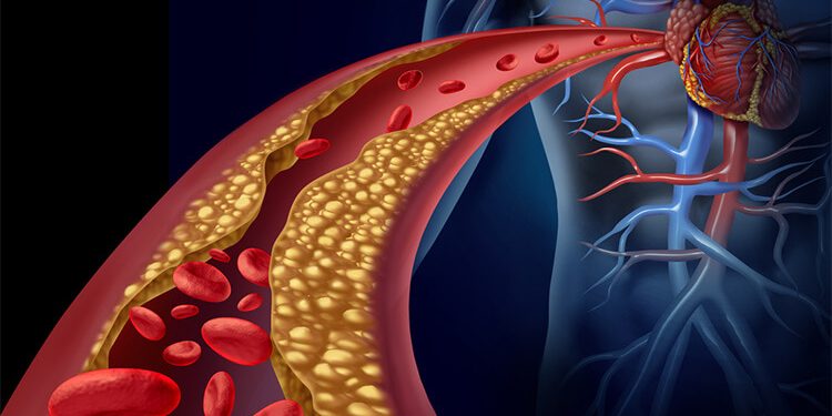 hiperlipidemia