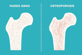 osteoporosis