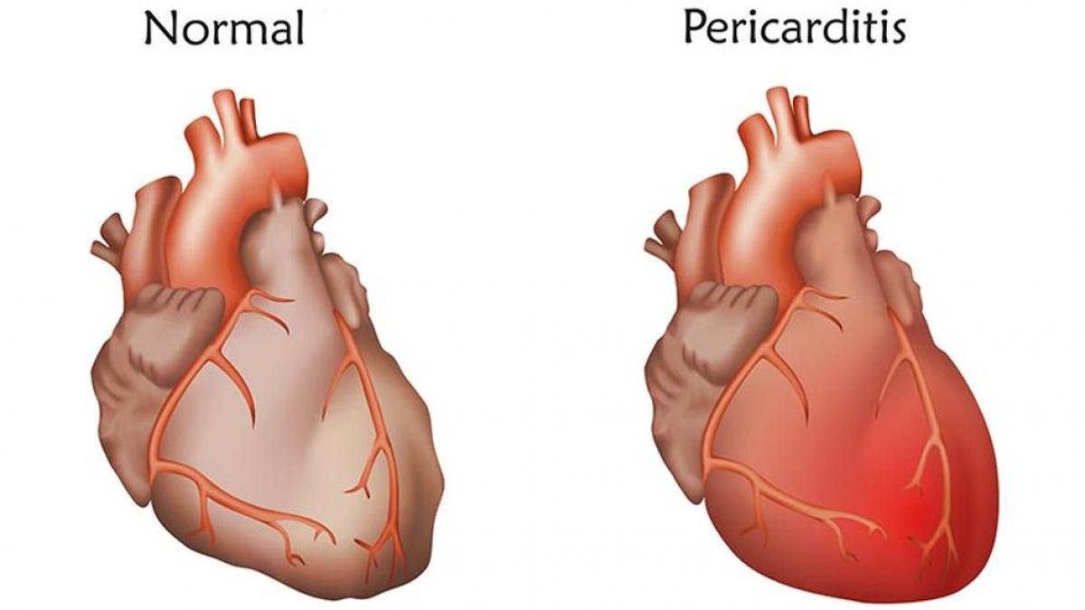 pericarditis