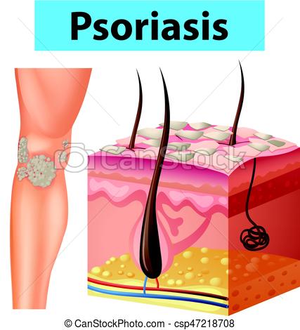 psoriasis