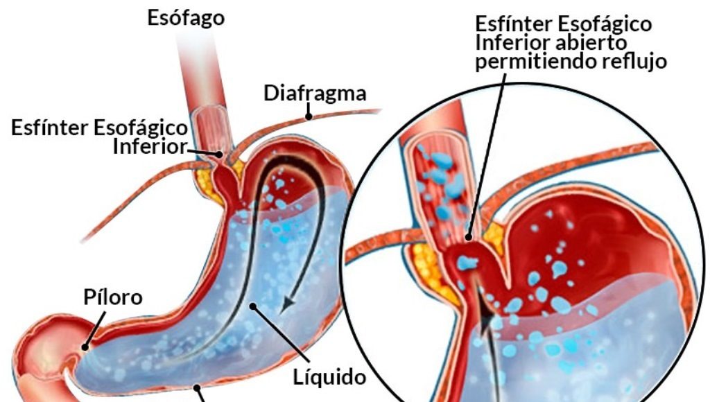 reflujo gastroesofajico