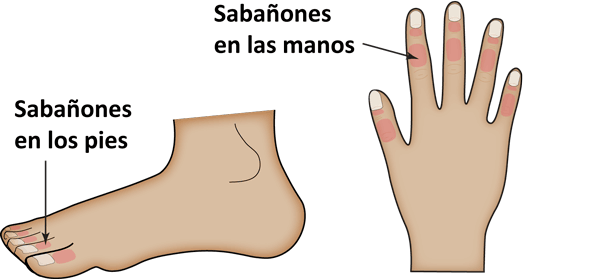 sabañones