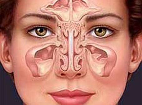 sinusitis