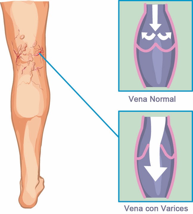 varices